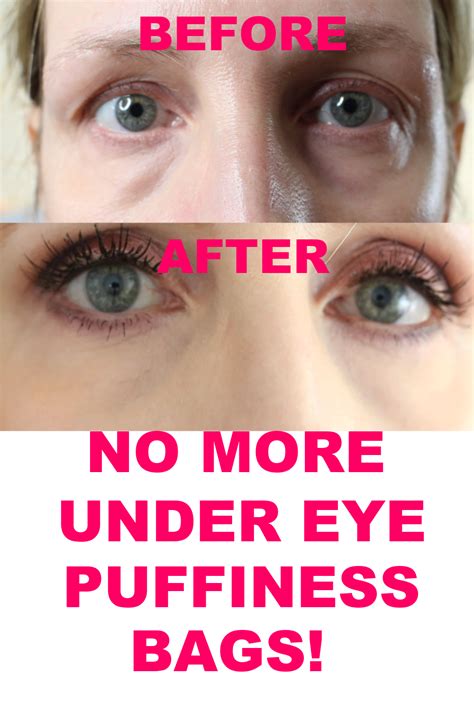 Makeup For Under Eye Puffiness Hot Sex Picture