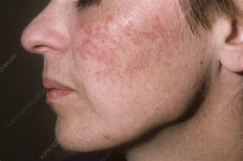 Acne Rosacea Stock Image C0465314 Science Photo Library