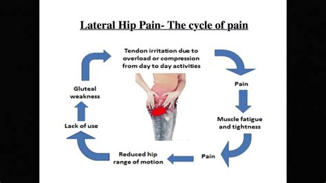 Advice How To Manage Your Lateral Hip Pain Youtube