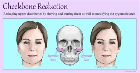 Cheekbone Reduction Pinkmirror Blog