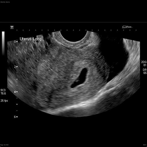 Haemorrhagic Ovarian Cyst Radiology Case