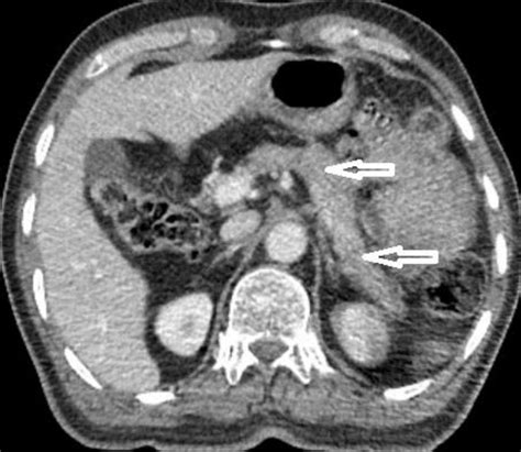 Axial Computed Tomography Scan Normal Looking Pancreas Gland With No