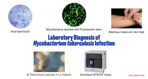 Updated tb testing and treatment recommendations. Laboratory Diagnosis of Mycobacterium tuberculosis ...