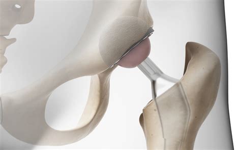 Fda Approves Hip Implant Using Coorstek Ceremic Medical Plastics News