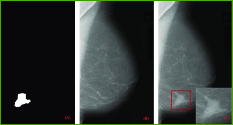 Given Mask Image A Normal Mammogram Image B Generated Mammogram