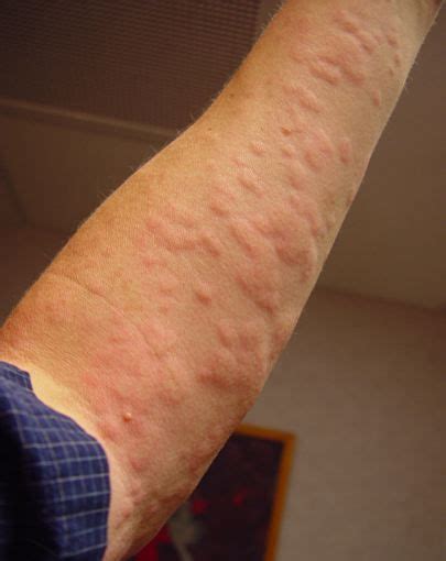 What Does Hives Look Like What Does It Look Like Find Out Here