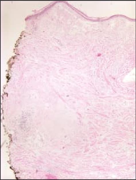 Figure 2 From Primary Localized Cutaneous Nodular Amyloidosis And Crest