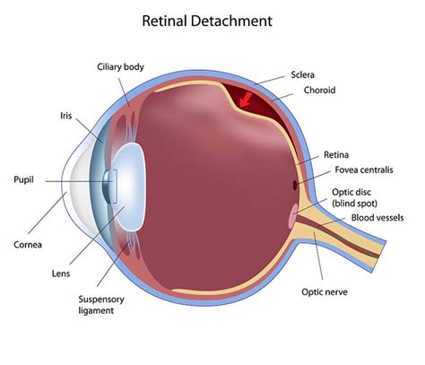 Retina Boston | Retinal Detachment Boston | NEEC