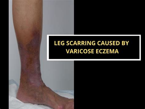 Cellulitis And Varicose Eczema How Can You Tell The Difference The