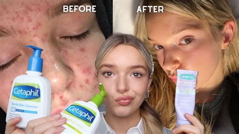 My ACCUTANE Journey How I Cleared My Acne YouTube