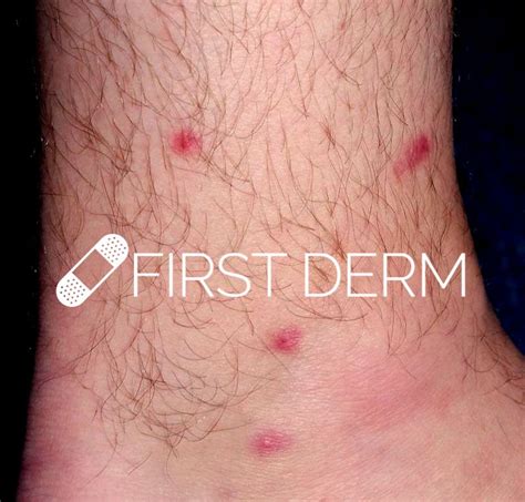 Itchy Red Bumps On Skin Potential Causes And Treatment
