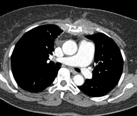 Lymphoma With Supraclavicular Nodes And Sternal Tumor Chest Case