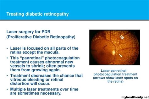Treatment Of Diabetic Retinopathy Risks And Prevention My Health Only