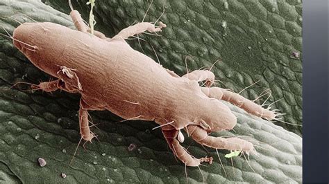 Microscopic Bug The Cause Of Rash Outbreak
