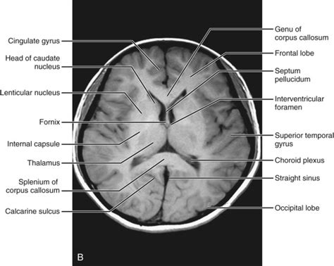 Frontal Lobe Anatomy Mri