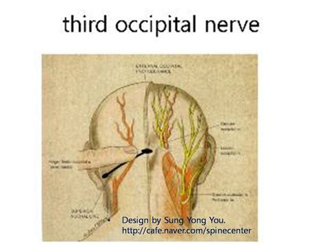 Third Occipital Nerve Headache Headache