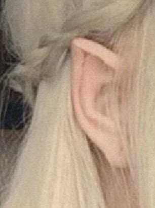 A pixie ear is characterized by a pulled or tethered earlobe (usually post facelift). Woman left with mutilated ears after surgery to make her ...