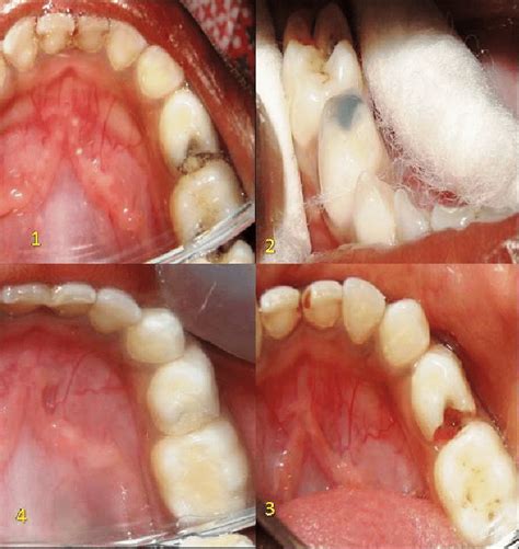 Removal Of Dental Caries Using Papain Gel Method On Posterior Primary