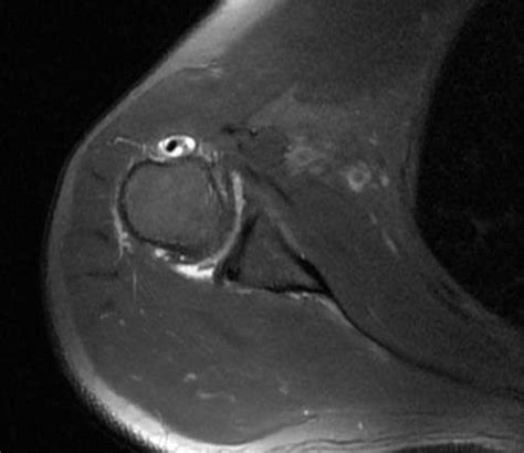 Mri Axial Image Fluid Appearance In The Biceps Tendon Sheath Biceps