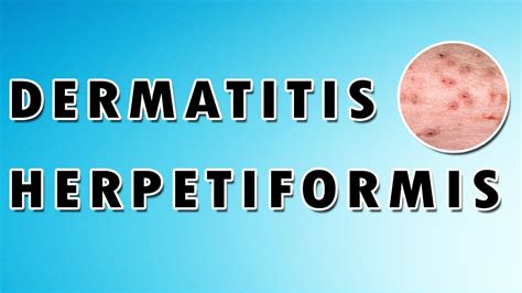 Dermatitis Herpetiformis Treatment Causes And Symptoms Dermatology