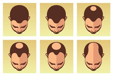 Cómo Medir La Alopecia En Hombres Escala Hamilton Norwood