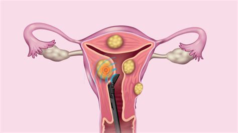 Endometriose Op Wie Lange Krank