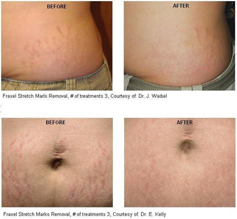 Top 99 Wallpaper Laser Treatments For Stretch Marks Before And After Pictures Full Hd 2k 4k