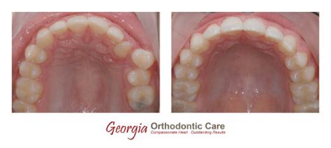 Dental Crowding Treatments Without Extraction