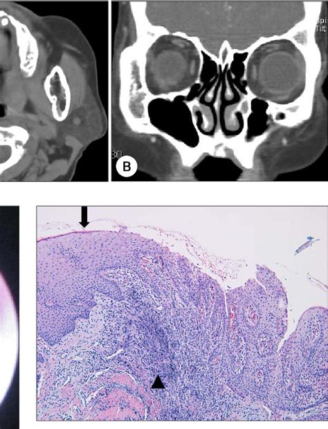 Figure 3 From A Case Of Nasal Septal Abscess Originated From