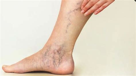 Advanced Veins And Vascular Management Blood Clot Legs Treatment Jackson Mi