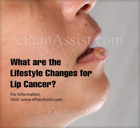 What Are The Lifestyle Changes For Lip Cancer