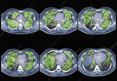 Interstitial Lung Disease Ct Scan Stock Image C0132185 Science