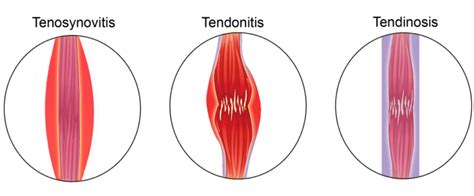 Suffering From Tendinopathy Or Achilles Tendonitis Learn All Your Options