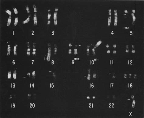 Karyotype Of A Hl 60 Hsr Cell Shown In Fig 1 Breakpoints Of Download Scientific Diagram