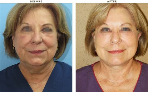 Mid Face Lift Before And After Pictures Dr Turowski Plastic