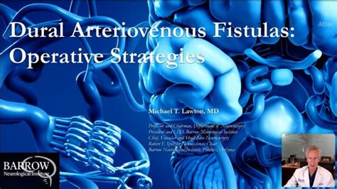 Dural Arteriovenous Fistulas Operative Strategies Grand Rounds