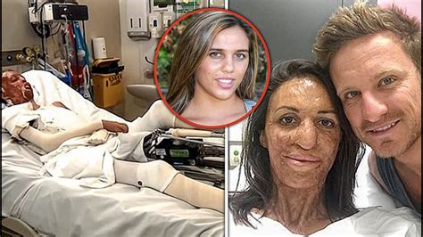 Turia Pitt Story Everything About Her Impressive Recovery From Burns
