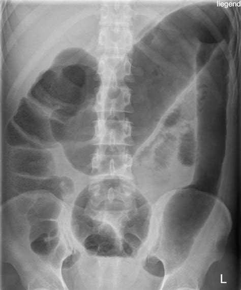 Abdominal X Ray Interpretation Axr Radiology Osce Geeky Medics