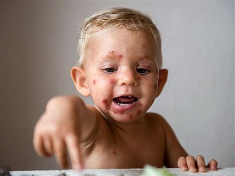 Impetigo Symptoms Causes Pictures And Treatment