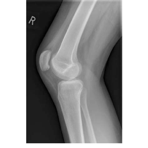 Lateral Radiograph Of Right Knee Illustrating Bony Protuberance On