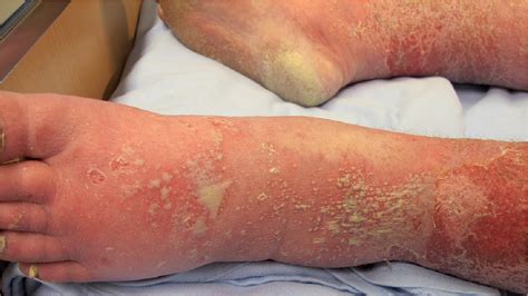 Secukinumab In The Treatment Of Generalized Pustular Psoriasis A Case