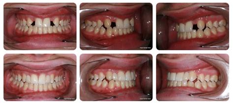 dental bridge and tooth bridges cosmetic dentist kingston london