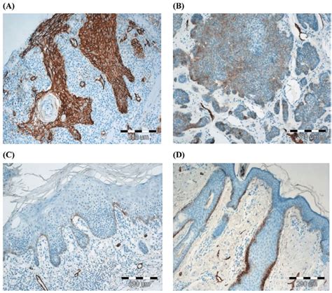 Podoplanin Expression In Sections Of Squamous Cell Cancer A Basal