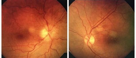 Optic Disc Edema In Right Fundus And Normal Apperence Of Left Optic