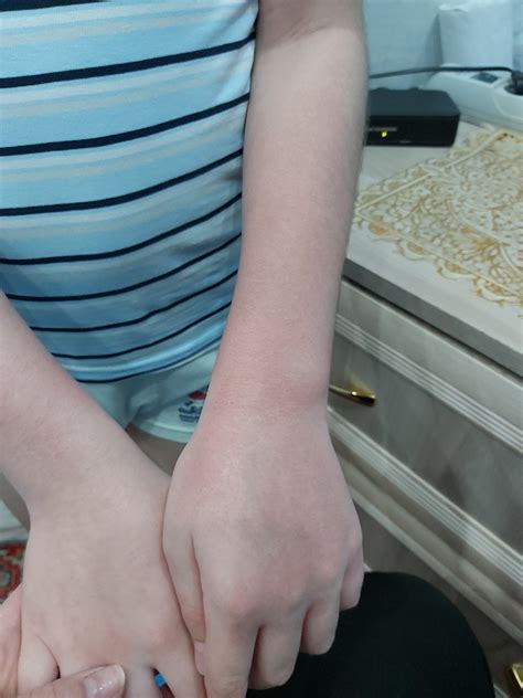 Сыпь у ребёнка на руках до локтя Вопрос дерматологу 03 Онлайн