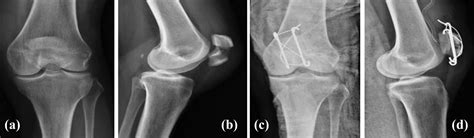 Treatment Of Displaced Fractures Of The Patella Tension Band Wiring