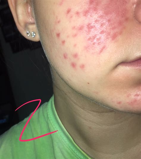 Inflamed Dehydrated Pores Dermatillomania Rosacea And Facial Redness