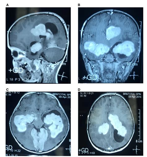 Figure 1 From Intracranial Rosai Dorfman Disease Presented With