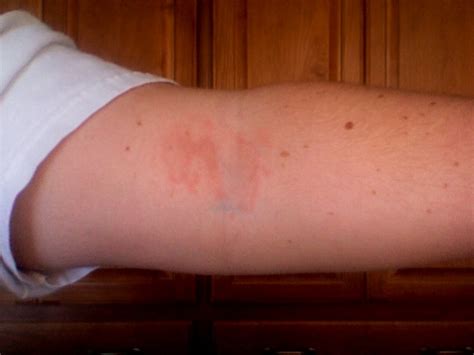 Guess That Rash Painful Infection Skin Arm Health And Wellness