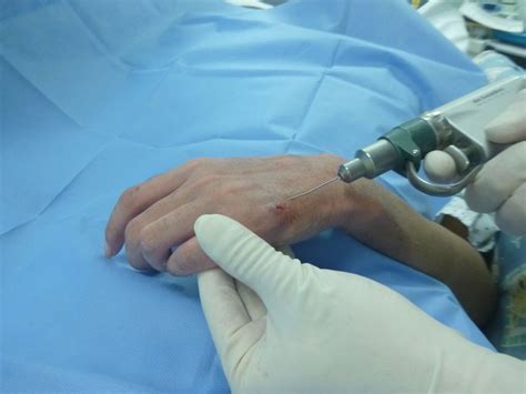 Removal Of A Kirschner Wire During Follow Up Of A Replantation Injury